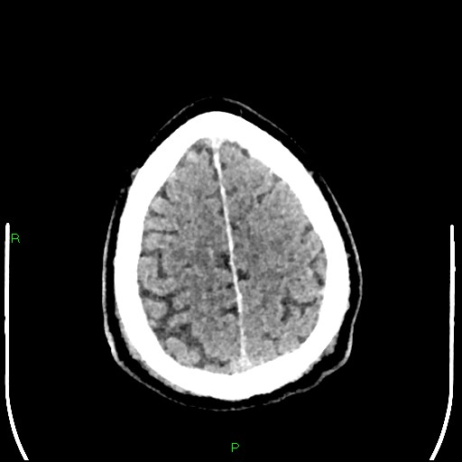 Cerebral contusions (Radiopaedia 33868-35039 Axial non-contrast 184).jpg