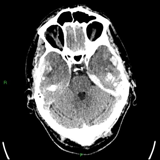 Cerebral contusions (Radiopaedia 33868-35039 Axial non-contrast 62).jpg