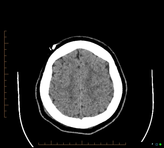 File:Cerebral fat embolism (Radiopaedia 85521-101220 Axial non-contrast 49).jpg