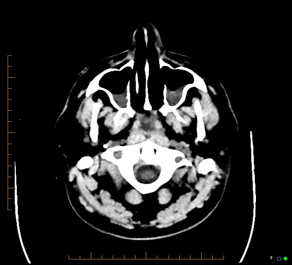 Cerebral fat embolism (Radiopaedia 85521-101220 Axial non-contrast 8).jpg