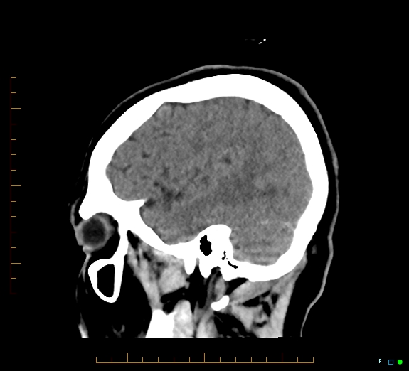 Cerebral fat embolism (Radiopaedia 85521-101220 B 42).jpg