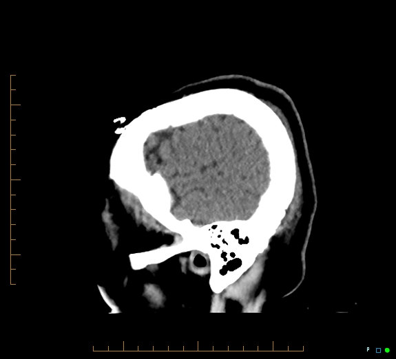Cerebral fat embolism (Radiopaedia 85521-101220 B 8).jpg