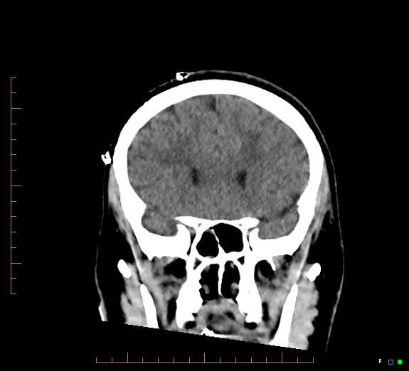 Cerebral fat embolism (Radiopaedia 85521-101220 Coronal non-contrast 22).jpg