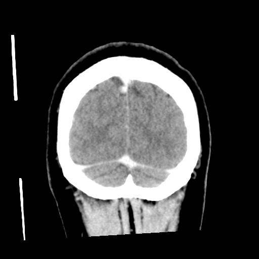Cerebral hemorrhage secondary to arteriovenous malformation (Radiopaedia 33497-34561 C 59).png