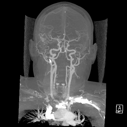 File:Cerebral hemorrhage secondary to arteriovenous malformation (Radiopaedia 33497-34571 A 20).png