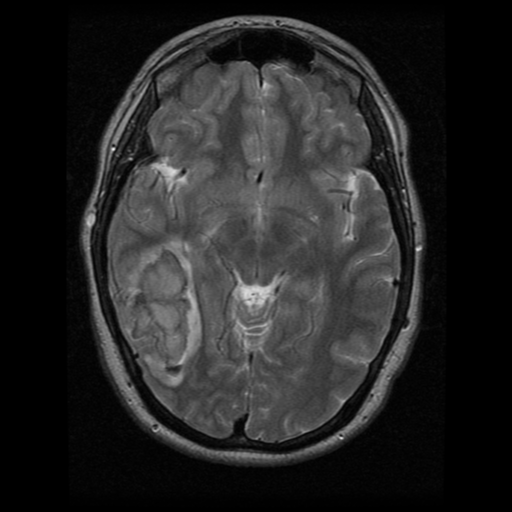 File:Cerebral hemorrhage secondary to arteriovenous malformation (Radiopaedia 33497-34572 Axial T2 11).png