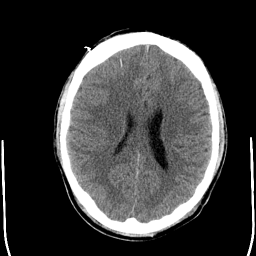 File:Cerebral hemorrhagic contusions- temporal evolution (Radiopaedia 40224-42754 Axial non-contrast 18).png
