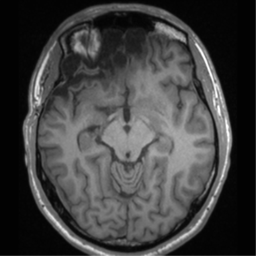 Cerebral hemorrhagic contusions- temporal evolution (Radiopaedia 40224-42757 Axial T1 32).png