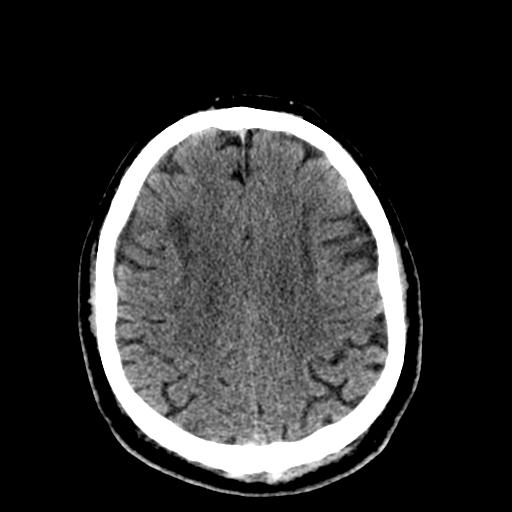 File:Cerebral hemorrhagic contusions and cervical spine fractures (Radiopaedia 32865-33841 Axial non-contrast 25).jpg