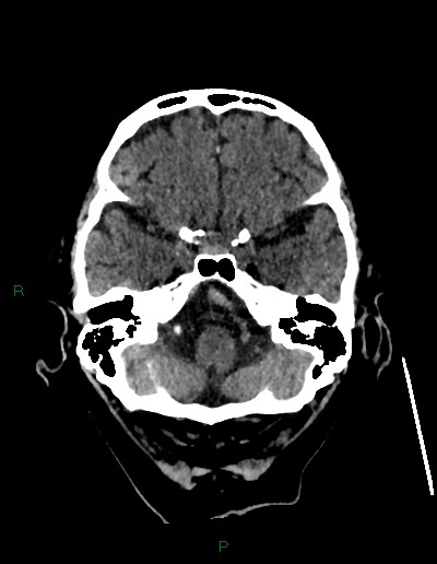 Cerebral metastases - ependymal and parenchymal (Radiopaedia 79877-93131 Axial non-contrast 12).jpg