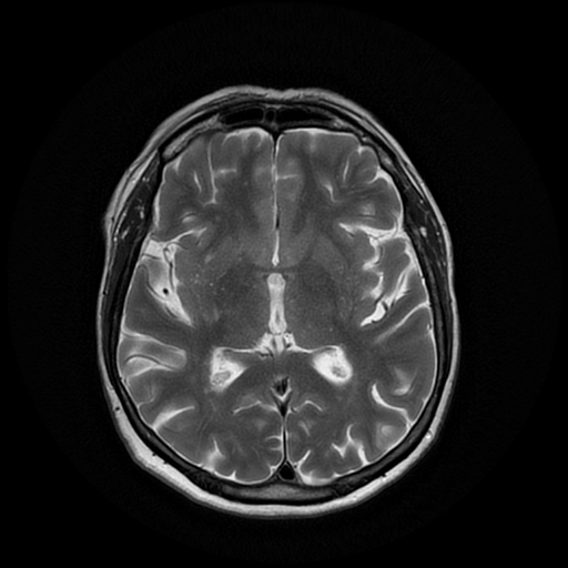 File:Cerebral metastases - melanoma (Radiopaedia 80972-94522 Axial T2 16).jpg