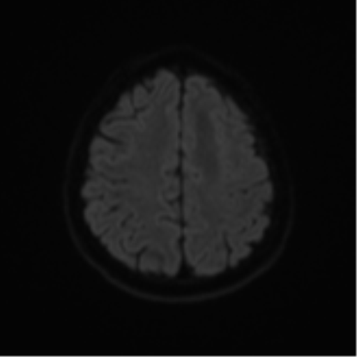 Cerebral metastases mimicking abscesses (Radiopaedia 45841-50131 Axial DWI 50).png