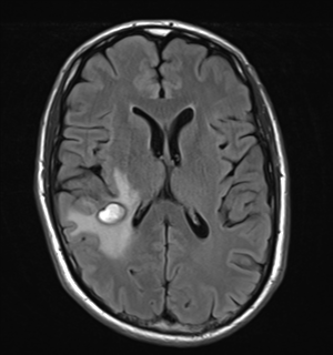File:Cerebral metastasis - melanoma (Radiopaedia 54718-60954 Axial FLAIR 17).png