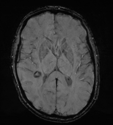 Cerebral metastasis - melanoma (Radiopaedia 54718-60954 Axial SWI 30).png