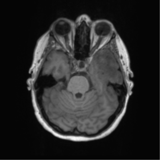 Cerebral metastasis mimicking glioblastoma (Radiopaedia 69155-78937 Axial T1 17).png