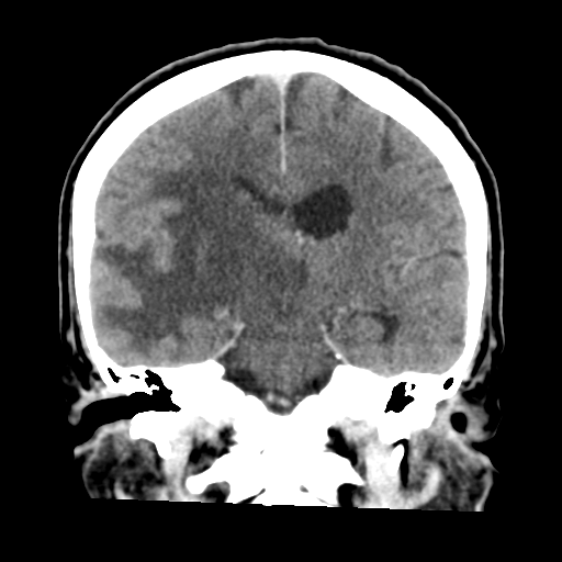 Cerebral metastasis to basal ganglia (Radiopaedia 81568-95412 Coronal C+ delayed 35).png