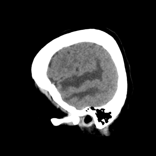 Cerebral metastasis to basal ganglia (Radiopaedia 81568-95412 E 13).png