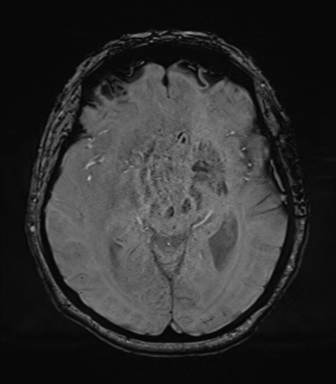 File:Cerebral metastasis to basal ganglia (Radiopaedia 81568-95413 Axial SWI 37).png