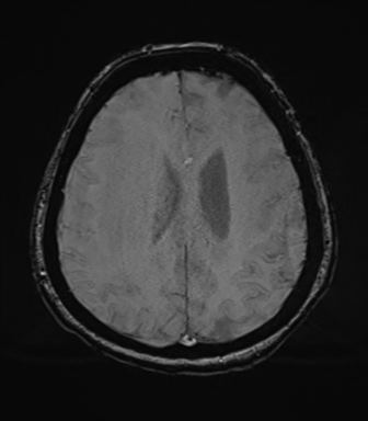 File:Cerebral metastasis to basal ganglia (Radiopaedia 81568-95413 Axial SWI 61).png
