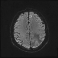 File:Cerebral toxoplasmosis (Radiopaedia 43956-47461 Axial DWI 16).jpg