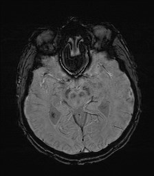 File:Cerebral toxoplasmosis (Radiopaedia 43956-47461 Axial SWI 17).jpg