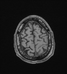 Cerebral toxoplasmosis (Radiopaedia 43956-47461 Axial T1 69).jpg