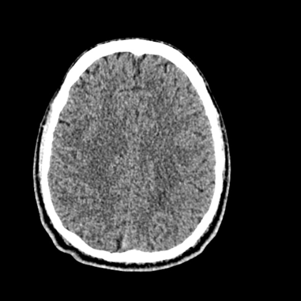 Cerebral toxoplasmosis (Radiopaedia 53993-60131 Axial non-contrast 56).jpg