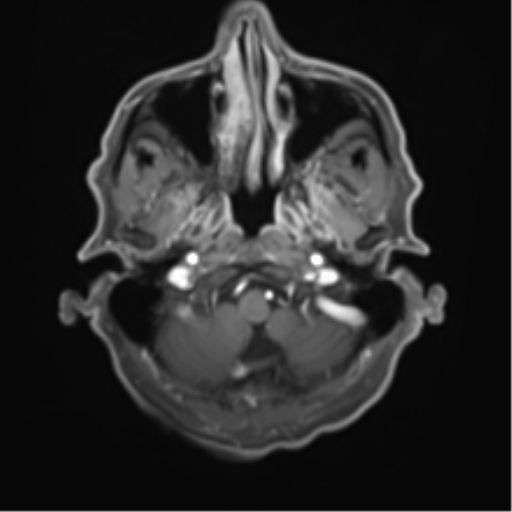 Cerebral toxoplasmosis (Radiopaedia 54575-60804 Axial T1 C+ 10).png