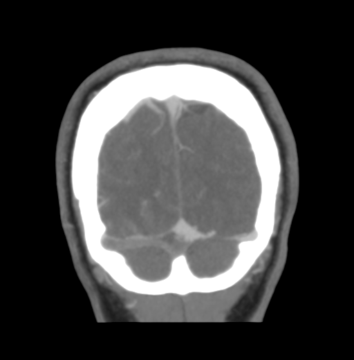 File:Cerebral venous hemorrhagic infarction (Radiopaedia 38461-40550 Coronal MIP VENOGRAM 53).png