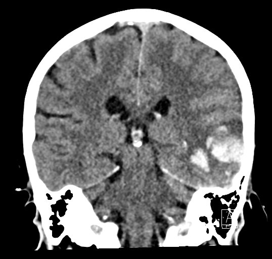 Cerebral venous infarction with hemorrhage (Radiopaedia 65343-74381 Coronal non-contrast 33).jpg