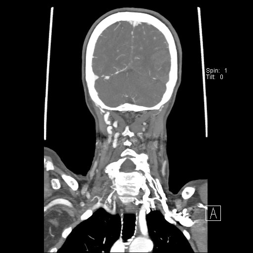 Cerebral venous infarction with hemorrhage (Radiopaedia 65343-74396 B 218).jpg