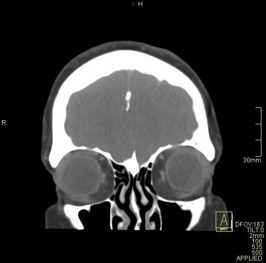 Cerebral venous sinus thrombosis (Radiopaedia 91329-108965 Coronal venogram 15).jpg