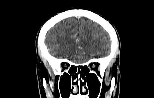 Cerebral venous thrombosis (CVT) (Radiopaedia 77524-89685 C 15).jpg