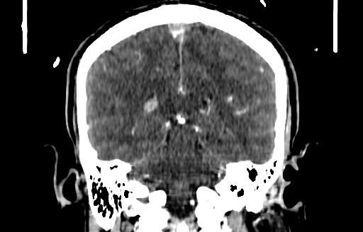 File:Cerebral venous thrombosis (CVT) (Radiopaedia 77524-89685 C 41).jpg