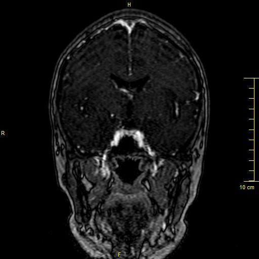 File:Cerebral venous thrombosis (Radiopaedia 23288-23351 MRV 61).JPG