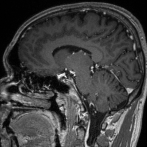 Cerebral venous thrombosis (Radiopaedia 38392-40469 Sagittal T1 C+ 41).png