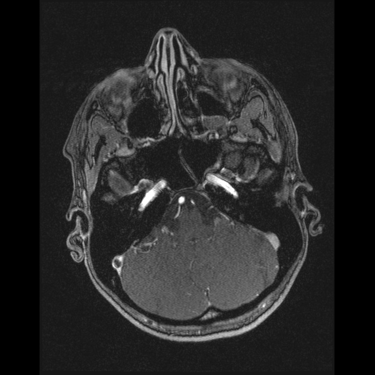 Cerebral venous thrombosis (Radiopaedia 45678-49854 Axial MRV 12).jpg