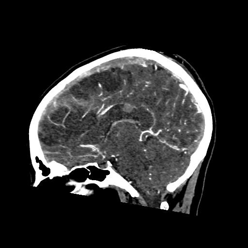 File:Cerebral venous thrombosis - hemorrhagic venous infarction (Radiopaedia 87318-103613 Sagittal 1).jpg