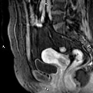 File:Cervical adenocarcinoma (Radiopaedia 65011-73985 E 16).jpg