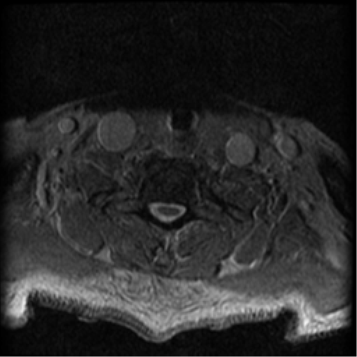 Cervical canal stenosis with cord compression (Radiopaedia 34114-35374 Axial Gradient Echo 19).png