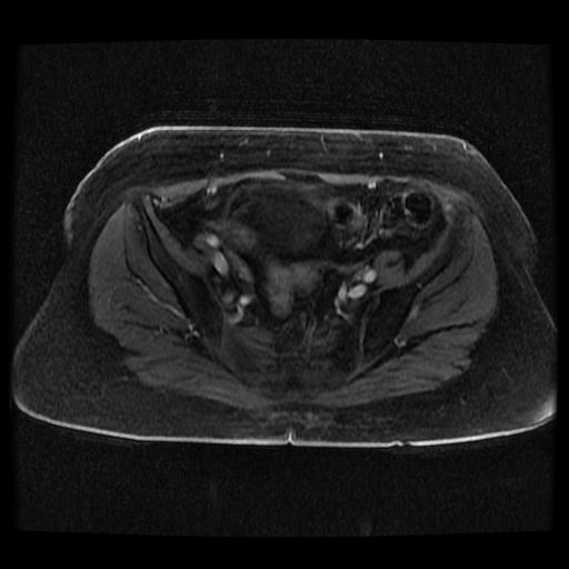 Cervical carcinoma (Radiopaedia 70924-81132 Axial T1 C+ fat sat 63).jpg