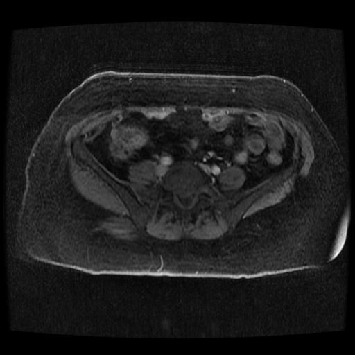 Cervical carcinoma (Radiopaedia 70924-81132 Axial T1 C+ fat sat 81).jpg