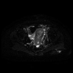 Cervical carcinoma (Radiopaedia 85405-101028 Axial DWI 10).jpg