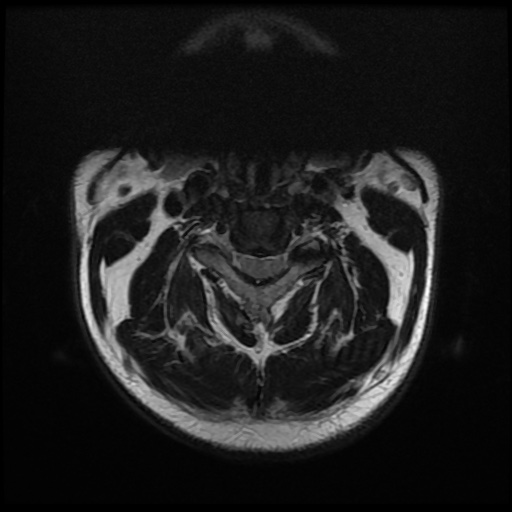 File:Cervical disc extrusion (Radiopaedia 59074-66364 Axial T2 2).jpg