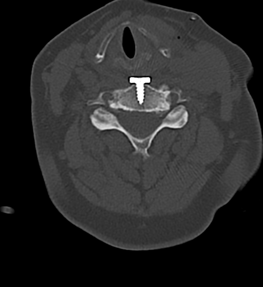 Cervical spine ACDF loosening (Radiopaedia 48998-54070 Axial bone window 35).png