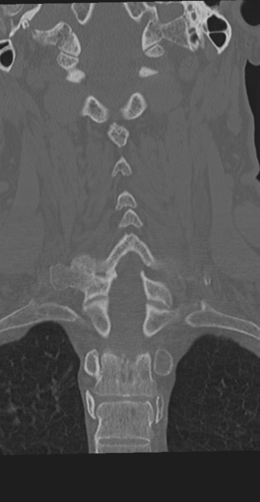 Cervical spine fracture in the setting of ankylosis (Radiopaedia 37038-38715 Coronal bone window 44).png
