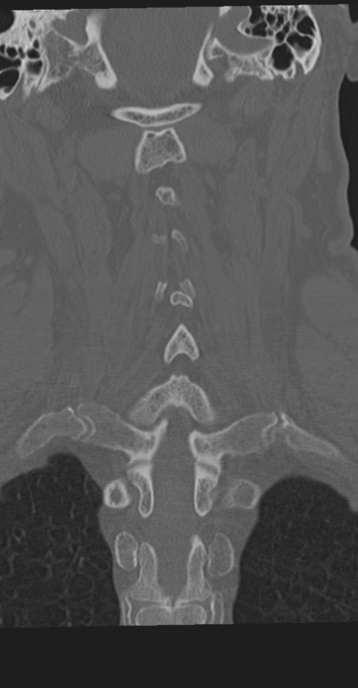 Cervical spine fracture in the setting of ankylosis (Radiopaedia 37038-38715 Coronal bone window 48).png