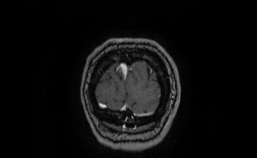 Cervical spondylodiscitis and calvarial hemangioma (Radiopaedia 64317-73103 Coronal T1 C+ 72).jpg