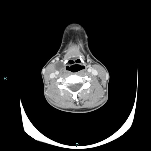 Cervical thymic cyst (Radiopaedia 88632-105335 C 61).jpg