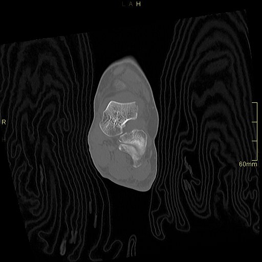 Chaput tubercle fracture (Radiopaedia 80319-93956 Coronal non-contrast 31).jpg